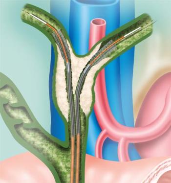 Tıkanma Sarılığında Safra Stenti Yerleştirilmesi